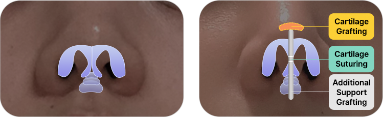 nose not implants method left 3 pc