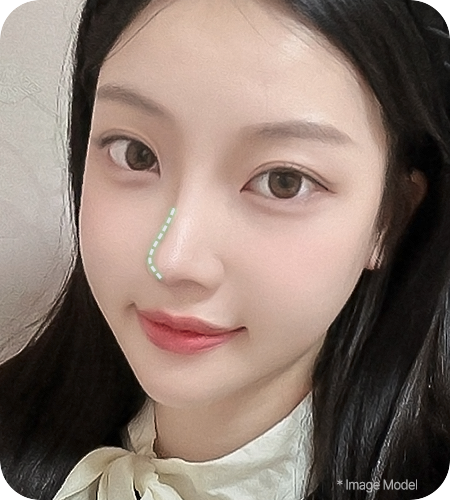 nose not implants method right 3 pc