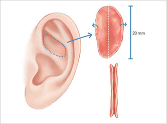 nose not implants type 1 mo