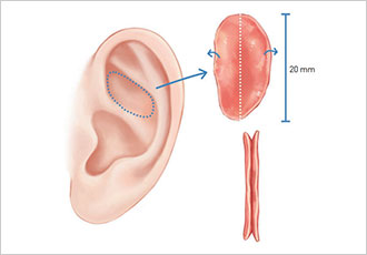 nose not implants type 1 pc