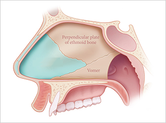 nose not implants type 2 mo