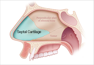 nose not implants type 2 pc