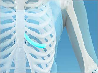 nose not implants type 3 mo