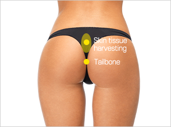 nose not implants type 4 mo