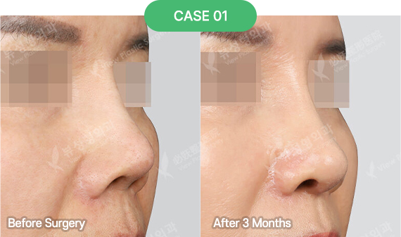 3D-CT Revision Rhinoplasty 29 nose reoperation bytype 1 1 pc