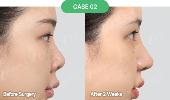 3D-CT Revision Rhinoplasty 30 nose reoperation bytype 1 2 pc