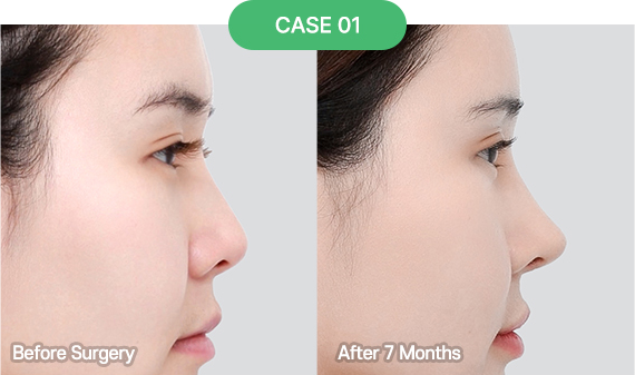 3D-CT Revision Rhinoplasty 31 nose reoperation bytype 2 1 pc