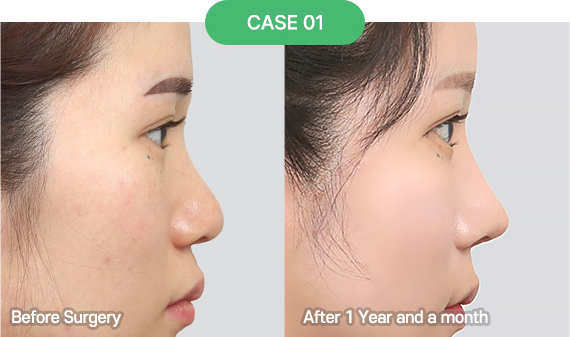 3D-CT Revision Rhinoplasty 33 nose reoperation bytype 3 1 pc