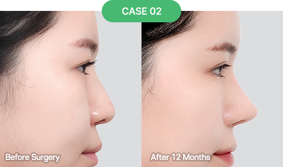 3D-CT Revision Rhinoplasty 34 nose reoperation bytype 3 2 pc