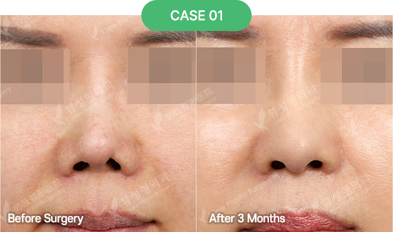 3D-CT Revision Rhinoplasty 35 nose reoperation bytype 4 1 pc