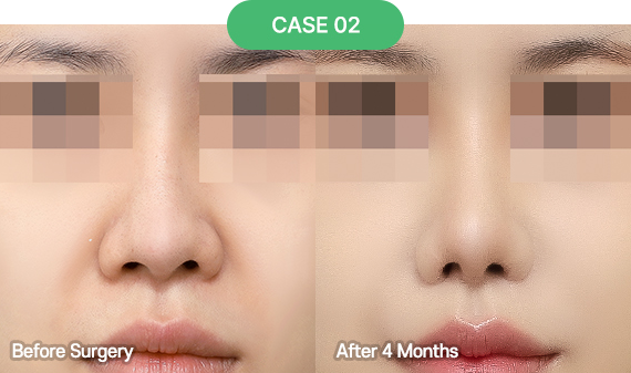 3D-CT Revision Rhinoplasty 36 nose reoperation bytype 4 2 pc