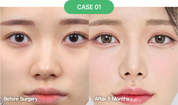 3D-CT Revision Rhinoplasty 37 nose reoperation bytype 5 1 pc