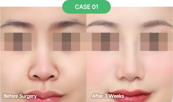 3D-CT Revision Rhinoplasty 39 nose reoperation bytype 6 1 pc