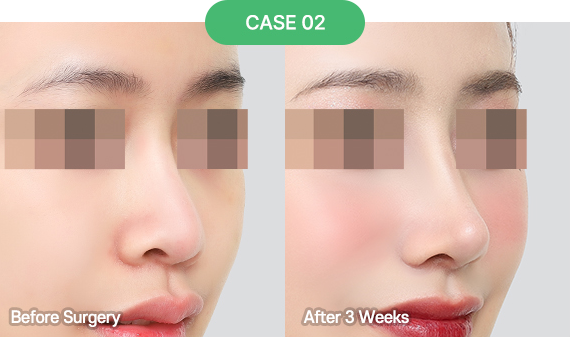 3D-CT Revision Rhinoplasty 40 nose reoperation bytype 6 2 pc