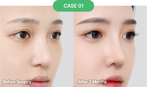 3D-CT Revision Rhinoplasty 41 nose reoperation bytype 7 1 pc