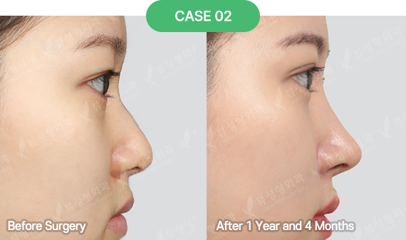3D-CT Revision Rhinoplasty 42 nose reoperation bytype 7 2 pc