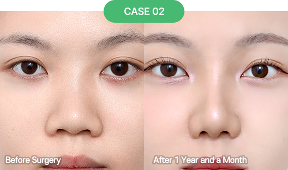 3D-CT Revision Rhinoplasty 32 nose reoperation case 2 2 pc
