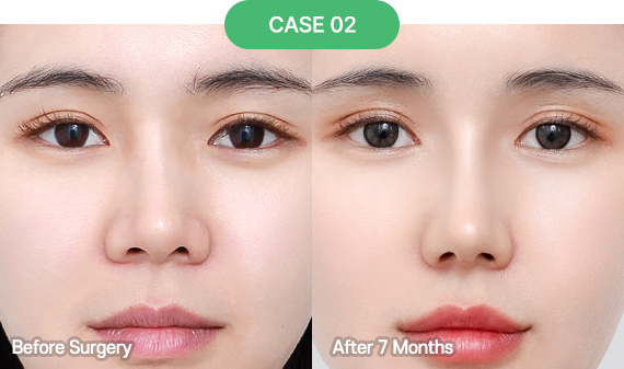 3D-CT Revision Rhinoplasty 38 nose reoperation case 5 2 pc