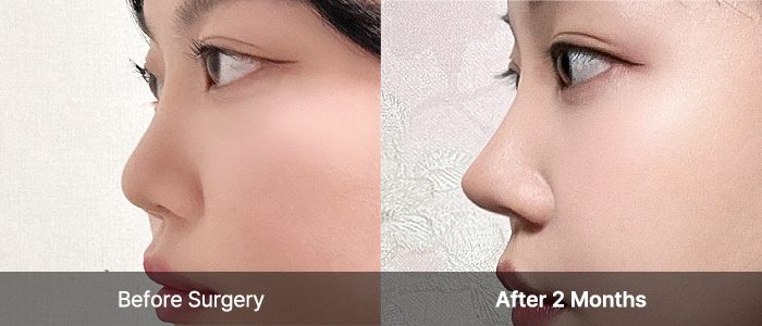 not implants viewart 2 mo