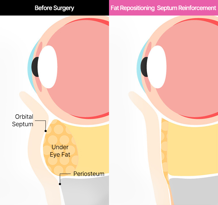 Under Eye Fat Reposition 32 province slide 3 mo