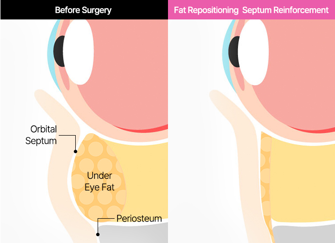 Under Eye Fat Reposition 31 province slide 3 pc