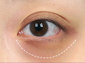 Under Eye Fat Reposition 38 province surgery 1 mo