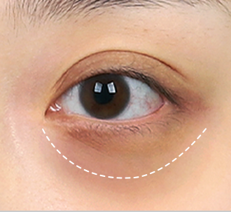 Under Eye Fat Reposition 37 province surgery 1 pc