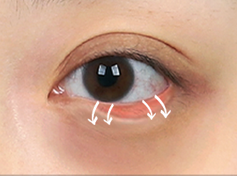 Under Eye Fat Reposition 40 province surgery 2 mo