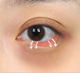 Under Eye Fat Reposition 39 province surgery 2 pc