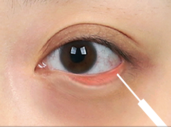 Under Eye Fat Reposition 42 province surgery 3 mo