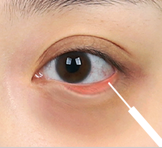 Under Eye Fat Reposition 41 province surgery 3 pc
