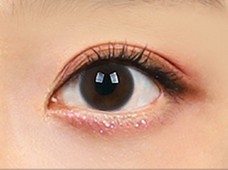 Under Eye Fat Reposition 44 province surgery 4 mo