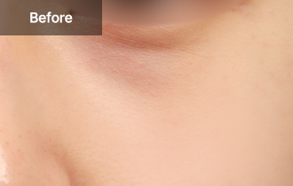 Under Eye Fat Reposition 45 province viewtist 1