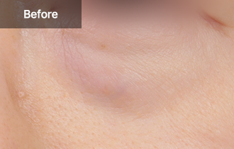 Under Eye Fat Reposition 49 province viewtist 3