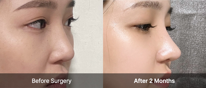 3D-CT Revision Rhinoplasty 26 reoperation viewart 2 mo