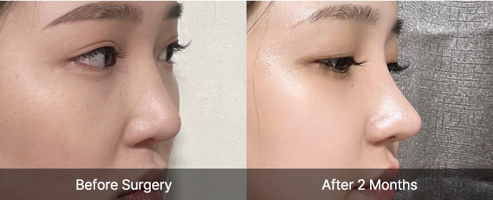 3D-CT Revision Rhinoplasty 25 reoperation viewart 2 pc
