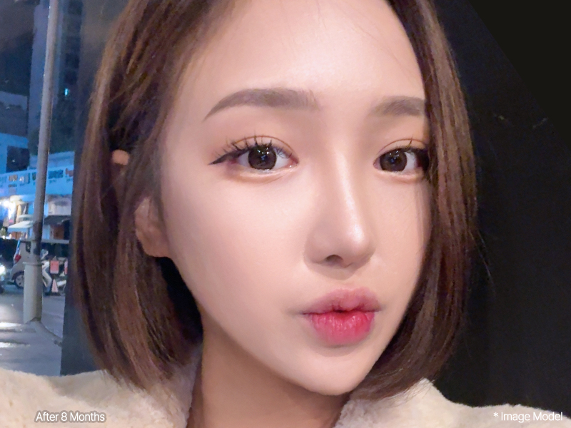 3D-CT Revision Rhinoplasty 24 reoperation viewart mo