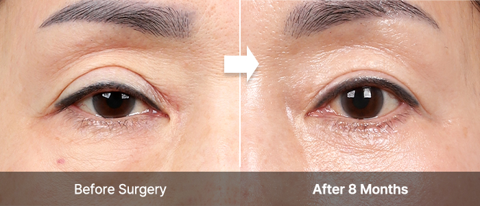 Blepharoplasty 26 upper lower correct right mo