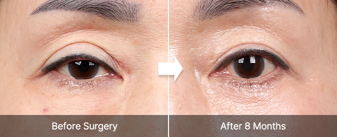 Blepharoplasty 25 upper lower correct right pc
