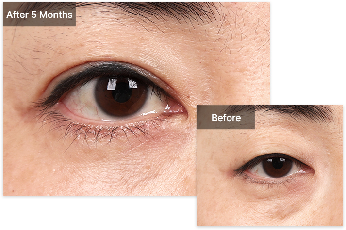 Blepharoplasty 30 upper lower lower mo