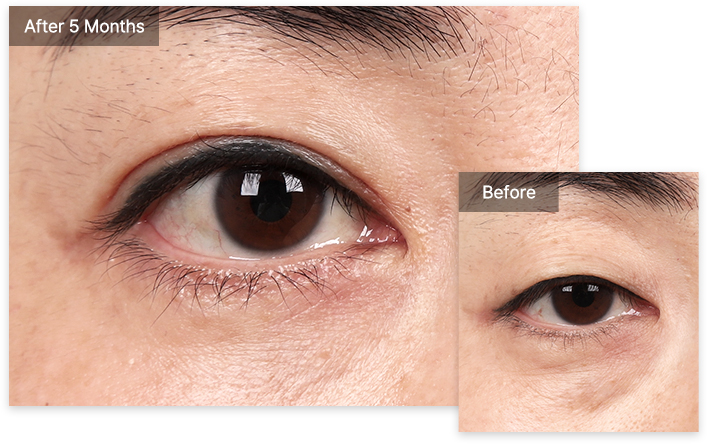 Blepharoplasty 29 upper lower lower pc