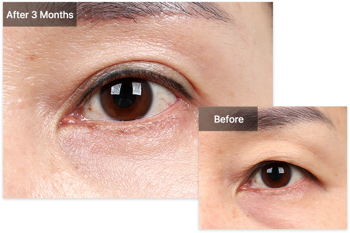 Blepharoplasty 28 upper lower upper mo