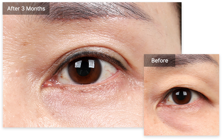 Blepharoplasty 27 upper lower upper pc