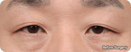 eye browliftmain gif