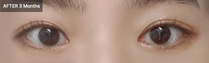 eye ptosis 01 after pc
