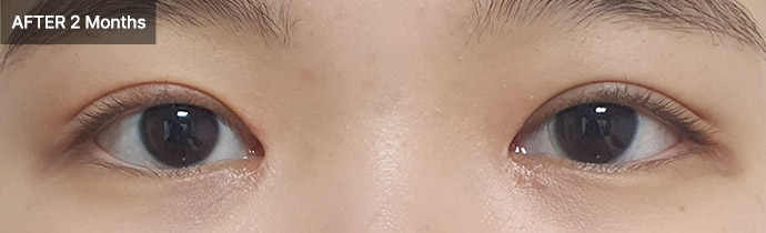 eye ptosis 02 after pc
