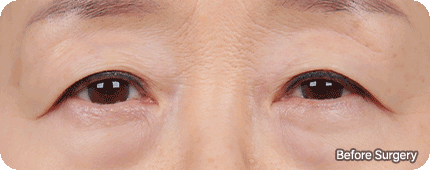 Blepharoplasty 15 eye upper lowermain gif
