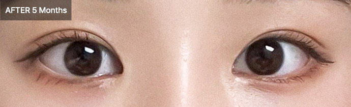 eyelid combo 01 after pc