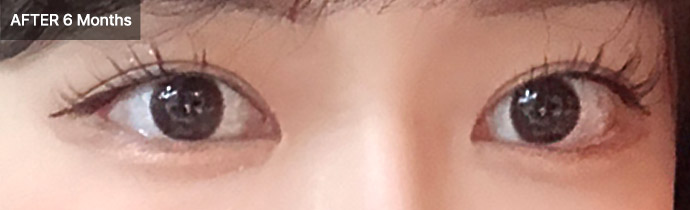 eyelid combo 02 after pc