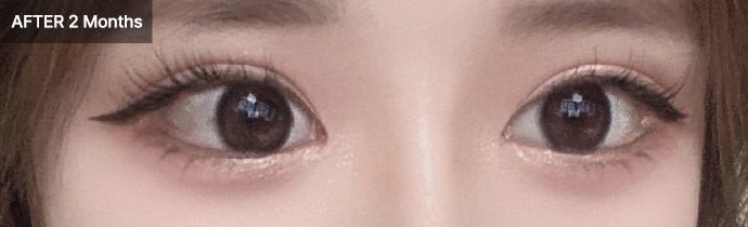 eyelid natural 01 after